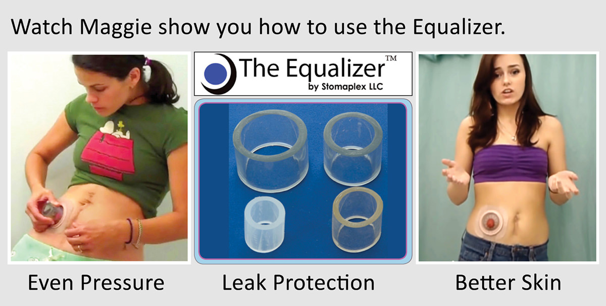 Stomaplex Ostomy Belts Ostomy Belt & Stoma Guard